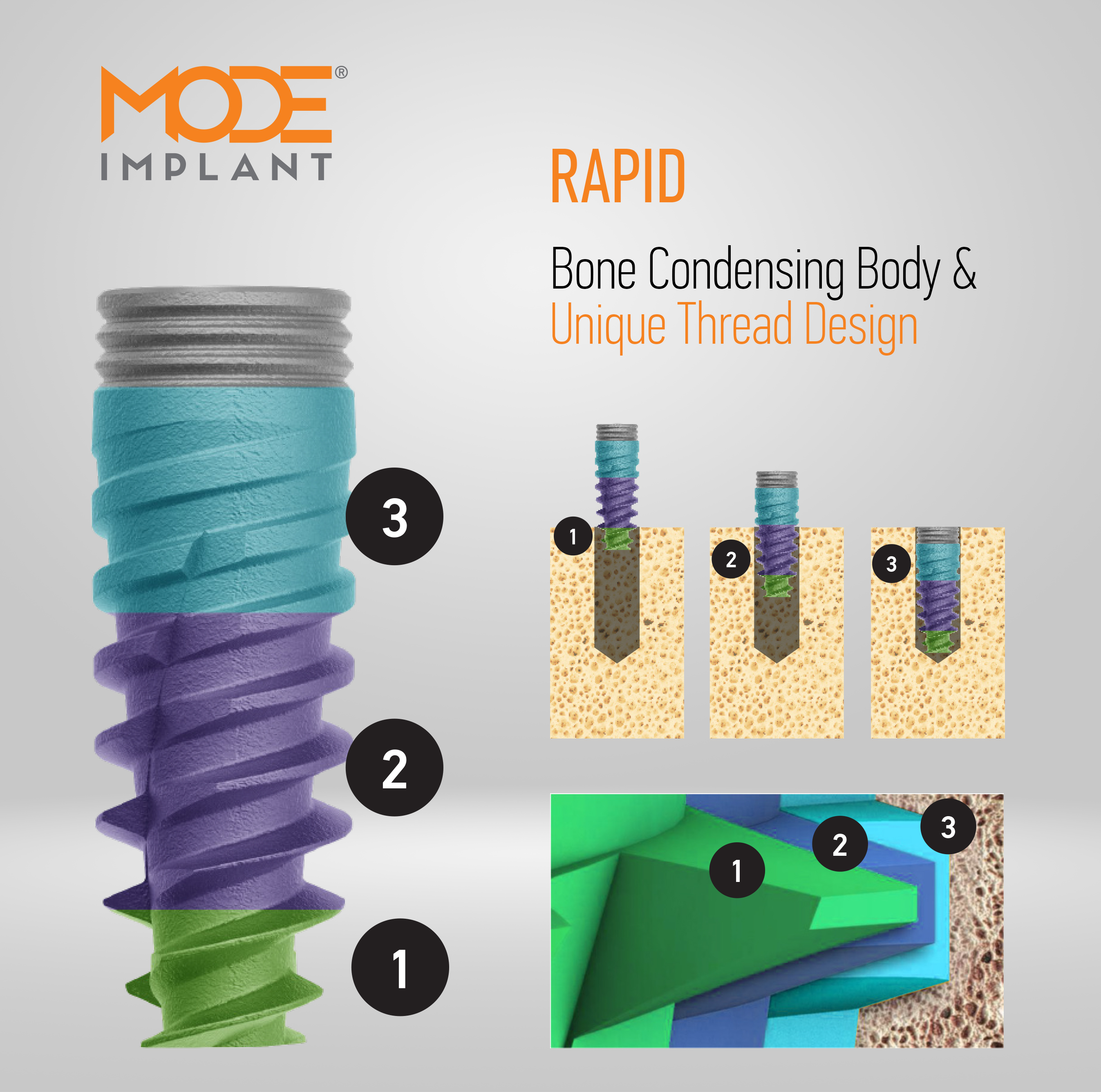 Bone Condensing Body & <br><span>Unique Thread Design</span>