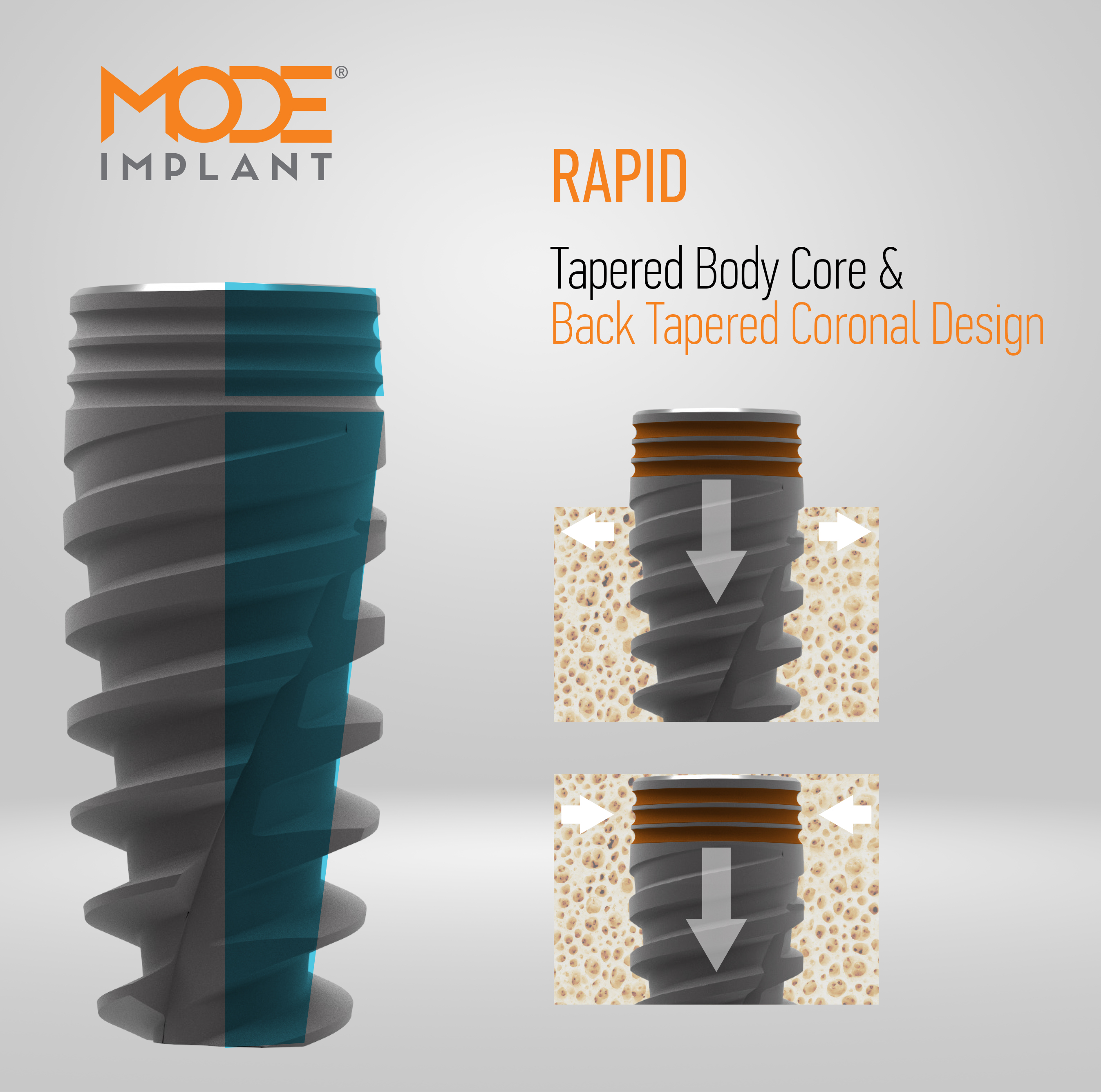 Tapered Body Core & <br><span>Back Tapered Coronal Design</span>